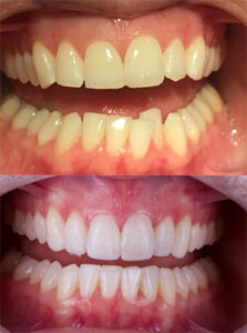 Invisalign aligners - Providing NHS and Private Dentistry